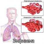 Emfizemul pulmonar - simptome primare și secundare, mecanism de dezvoltare a bolii și semne pe raze X Cum este descris emfizemul pulmonar pe raze X