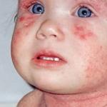 Children's dermatitis: why does it occur, what does it look like, why is it dangerous and how to treat?